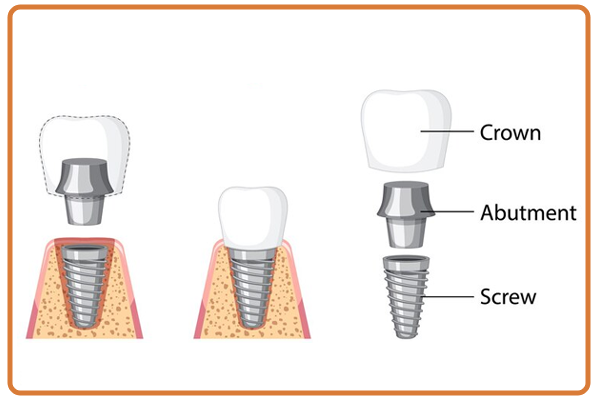 Dental Implants