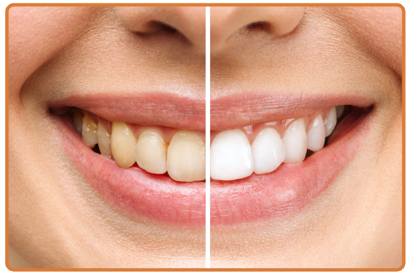 Teeth Whitening