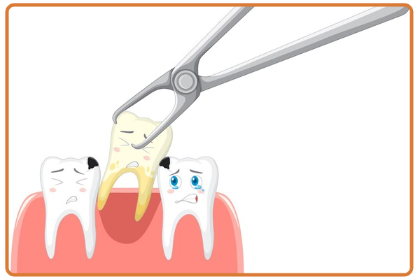 Wisdom Tooth Extraction
