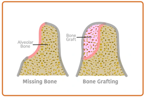 Bone Grafting Surgery